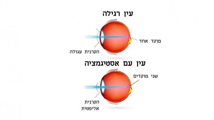 מה זה צילינדר בעין או אסטיגמציה - Astigmatism?