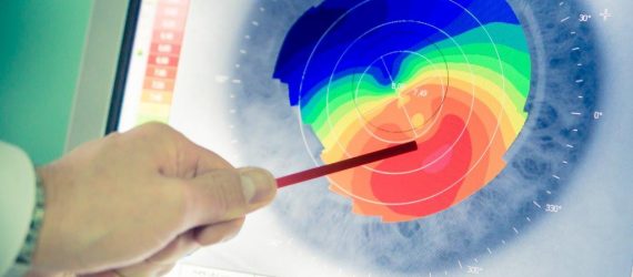 קרטוקונוס: כל מה שצריכים לדעת